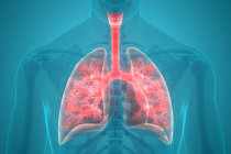 Quando pensar em pneumonia at&iacute;pica?